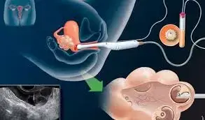  A New Ray Of Hope For Couples Dreaming Of Parenthood