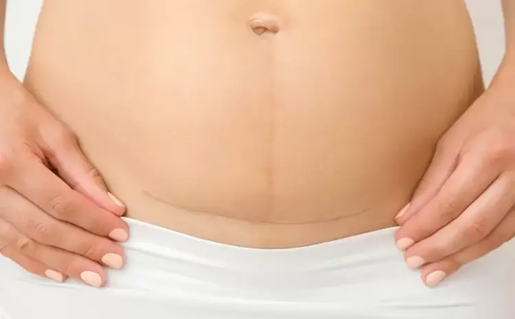  How to Ease Discomfort After a C-Section