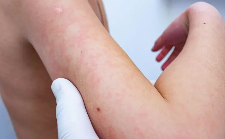  Getting Rashes in the Heat? Here’s What to Do