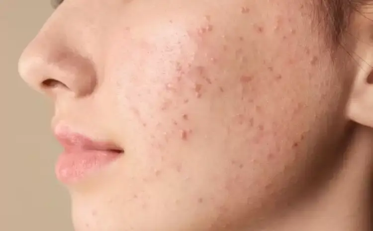  Why Do Pimples Get Worse in Summer?