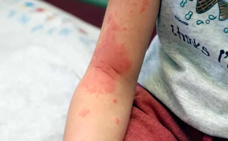  Why Do Kids Get More Rashes in Summer?