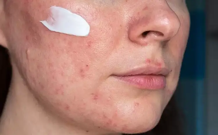  Face Turns Red After Sun Exposure? What It Means