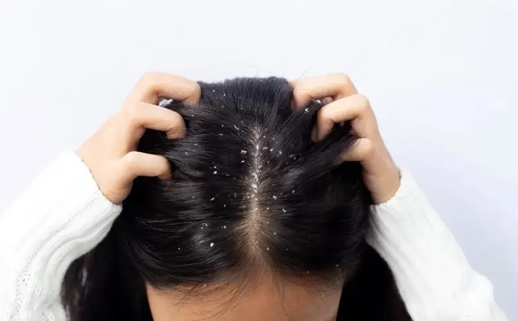  Can You Get Dandruff in Summer? Yes—Here’s Why