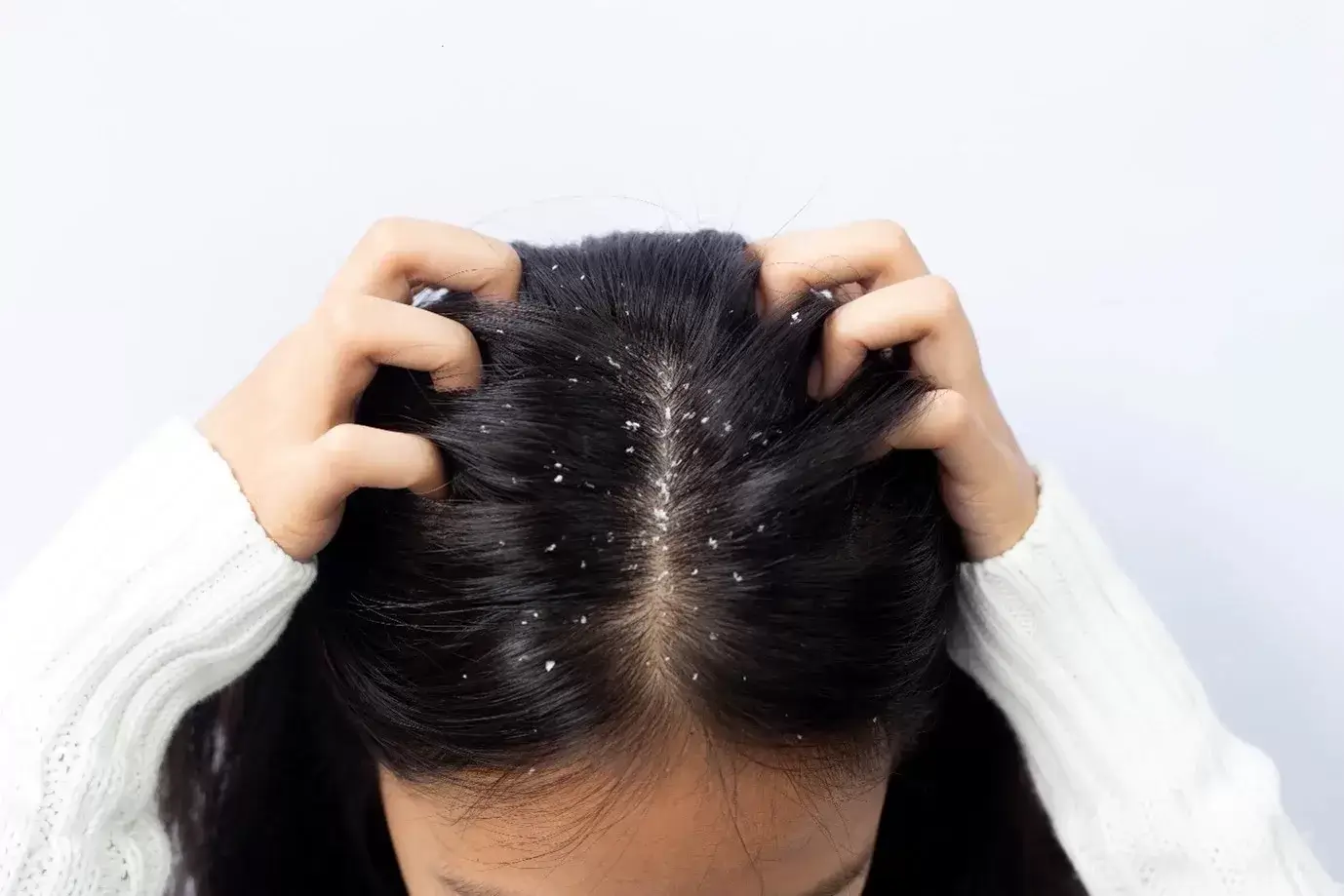 Dandruff Treatment