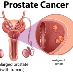 Prostate Cancer