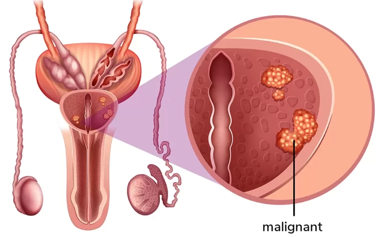  Prostate Cancer: Early Signs Every Man Should Know