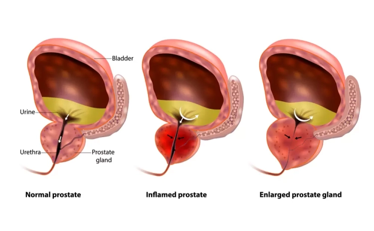  Enlarged Prostate: Symptoms, Risks, and Modern Treatments