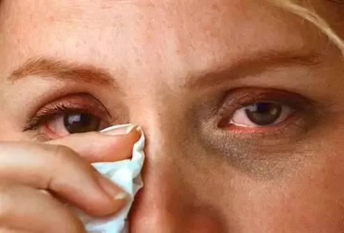  Eye Specialist Insights on Managing Eye Allergies