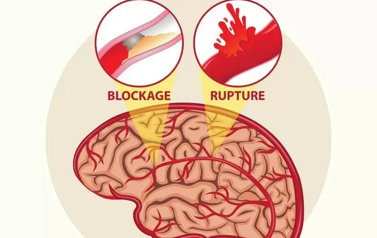  Life After a Brain Stroke: Real Steps to Regain Strength and Balance