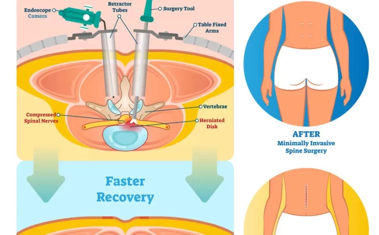  How Minimally Invasive Spine Surgery Reduces Pain and Recovery Time