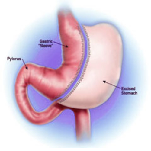 Bariatric Surgery Tulip Hospital Sonipat