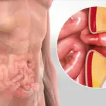 Understanding Hernia Surgery: Types, Recovery, And Risks